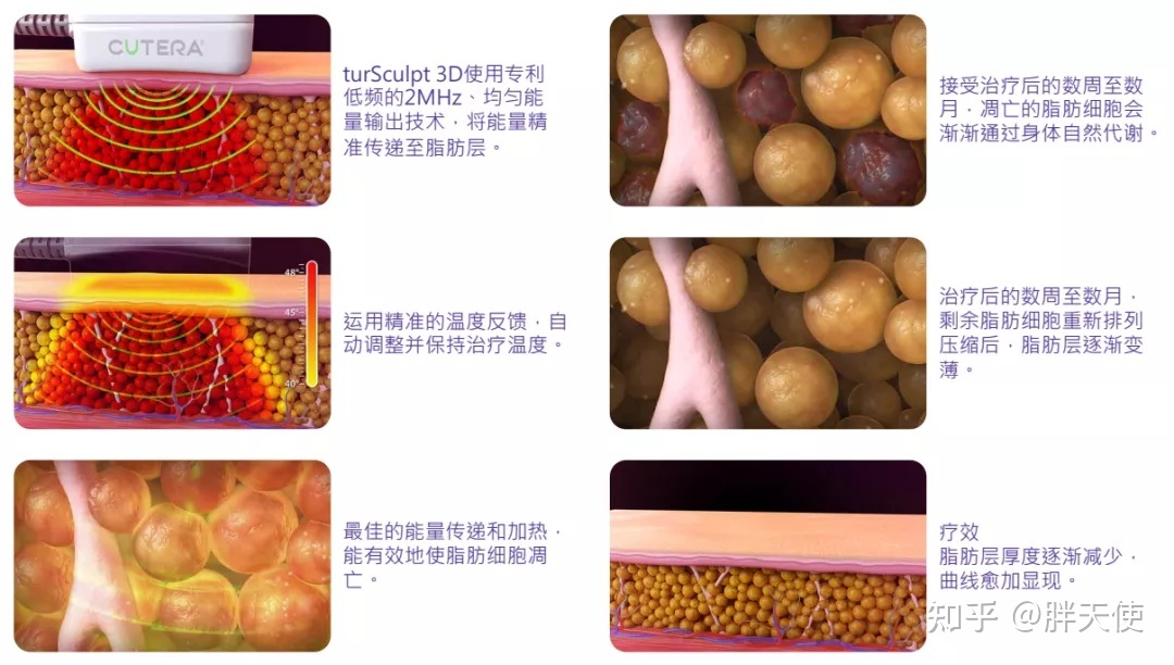 溶脂针最新版，技术革新与应用展望